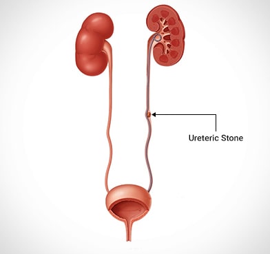 Ureteric Stone