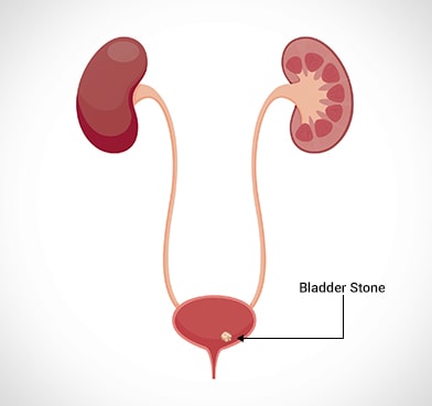 bladder stone surgery in Delhi