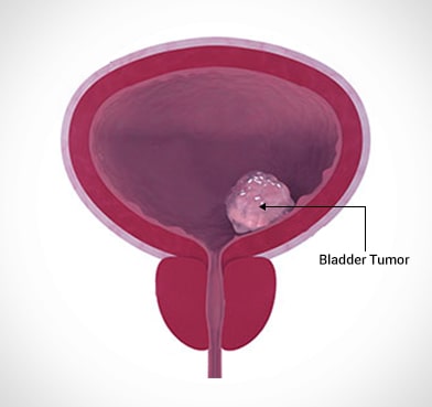 Bladder Cancer Surgery Hospital in Delhi