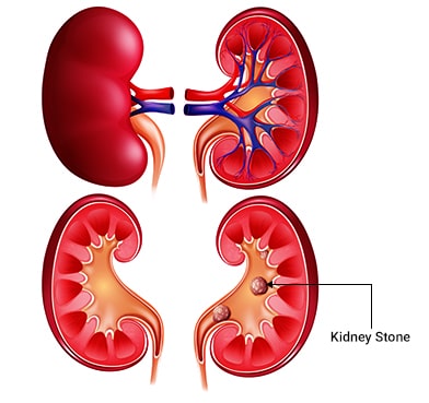 Kidney Stone